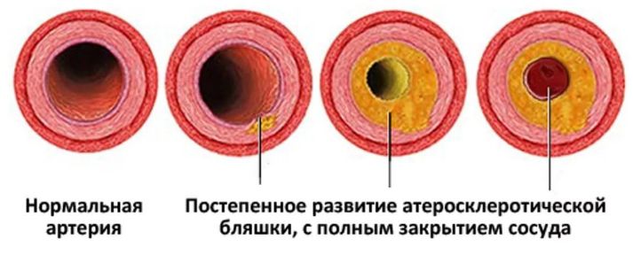 Липидограмма