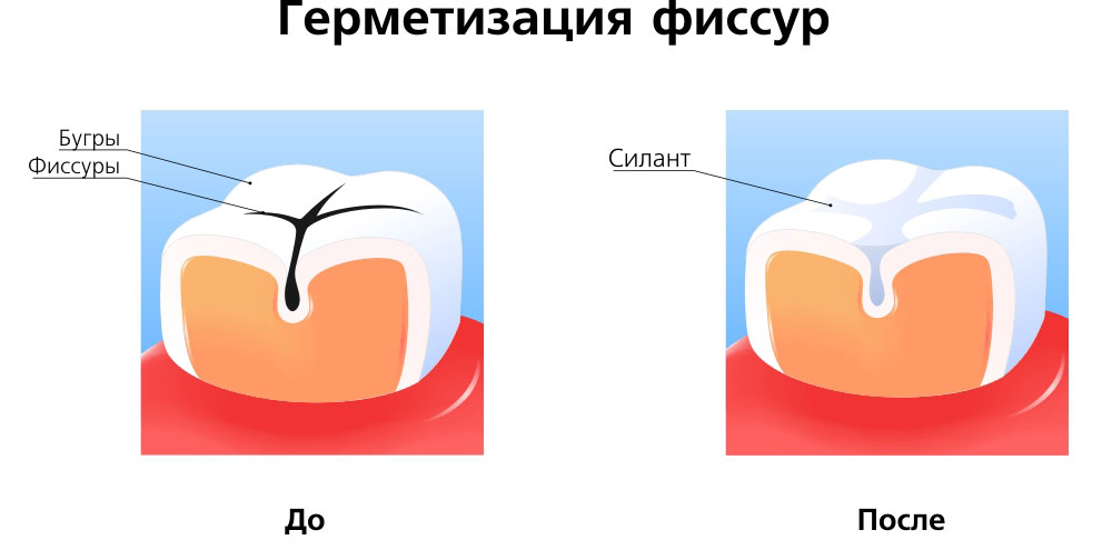 Герметизация фиссур до и после процедур очистки