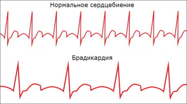 Что показывает ЭКГ - Брадикардия