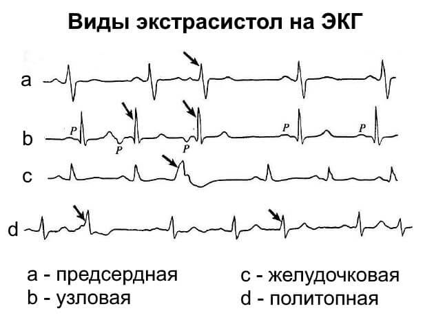 Виды экстрасистол на ЭКГ