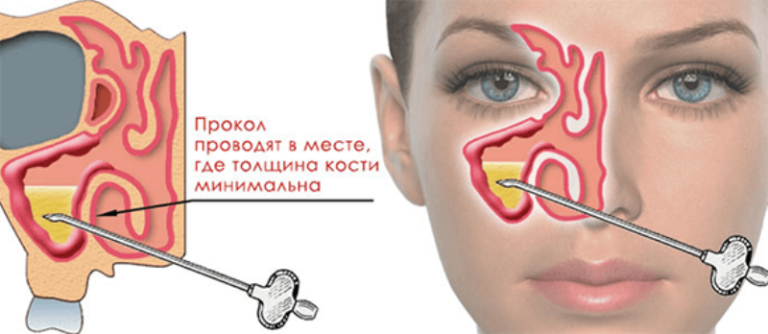 Прокол при гайморите