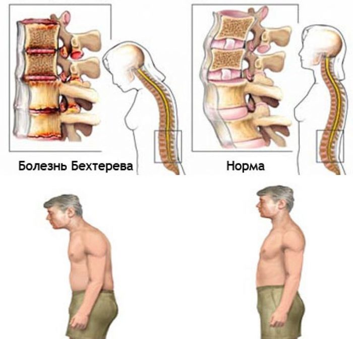 диагноз болезнь Бехтерева