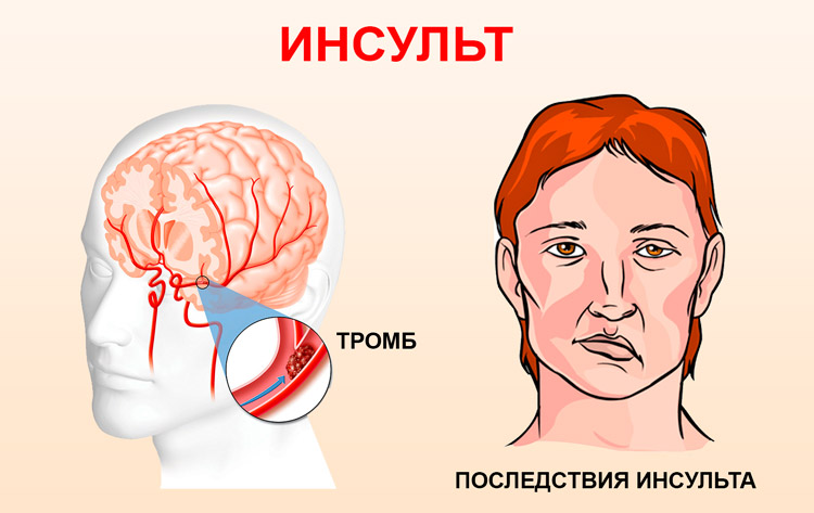 инсульт