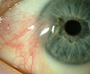 membrana epiretinalnaya
