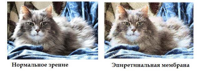эпиретинальная мембрана 