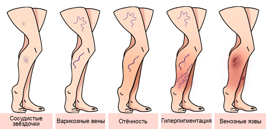 Стадии развития варикоза