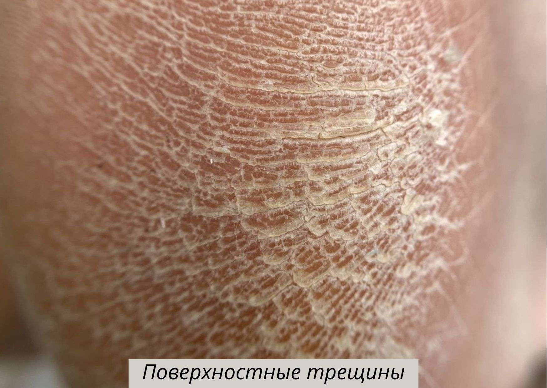 поверхностные трещины