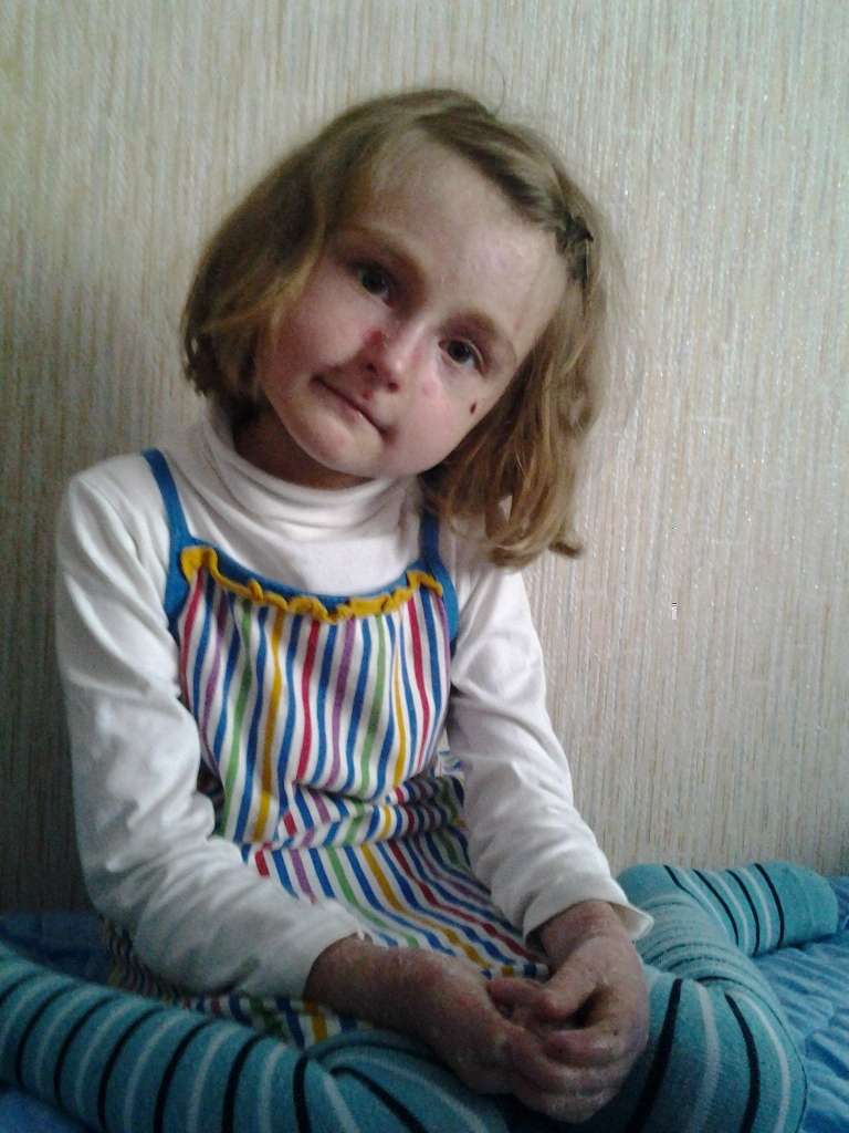 Генетическое заболевание кожи