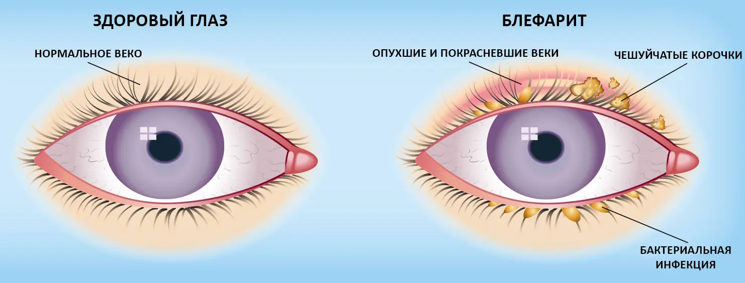 Сравнение здорового глаза и с блефаритом