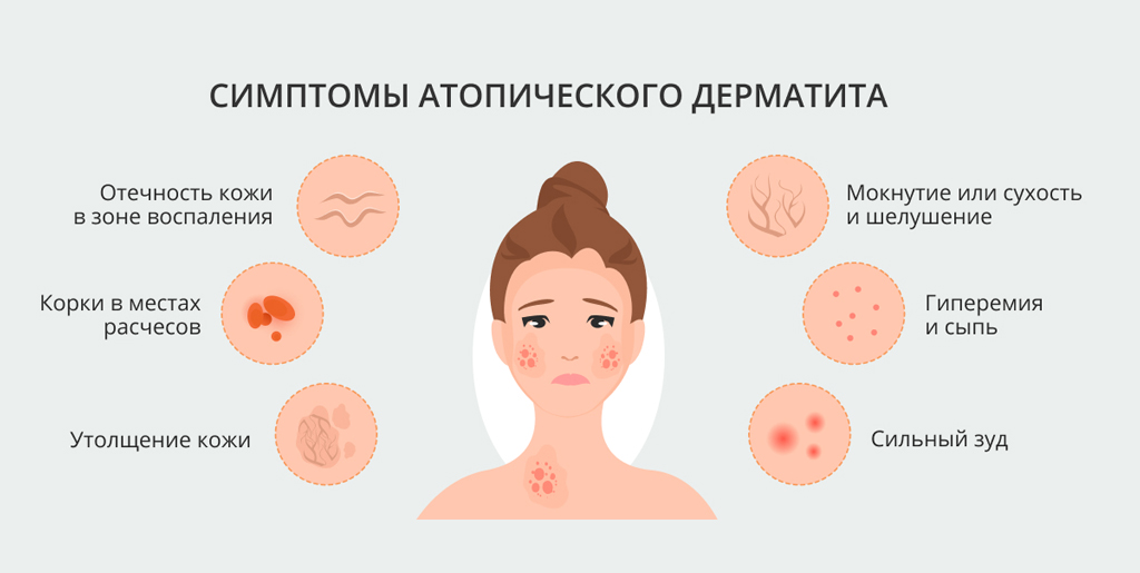 симптомы атопического дерматита