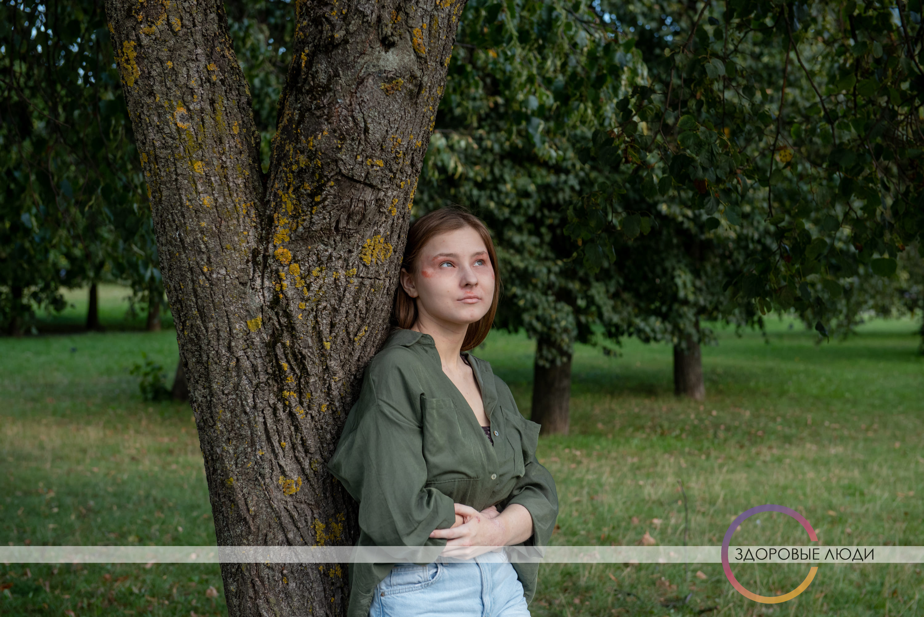 атопический дерпматит