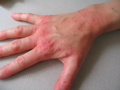 Аллергия на цитрусовые у детей и взрослых