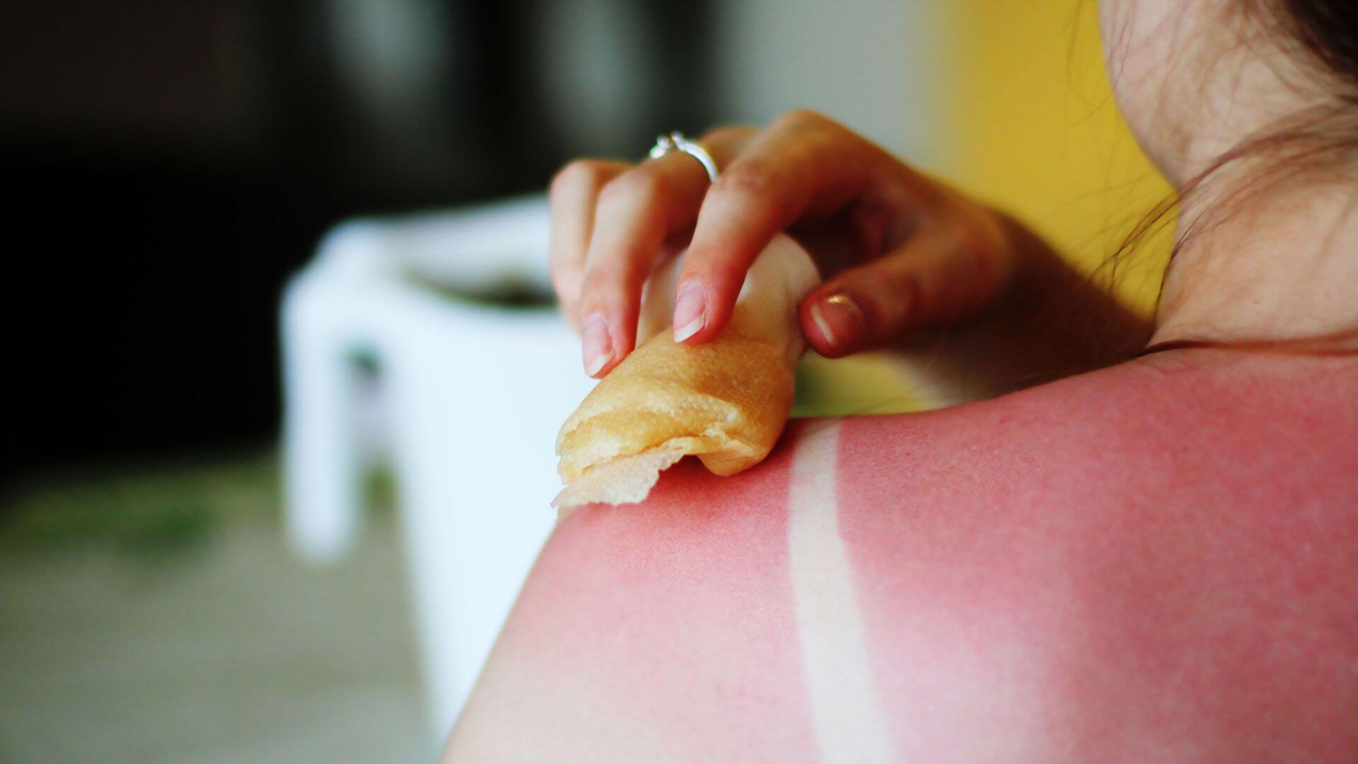 Кожа сгорела на солнце: советы дерматологов и разбор ошибок | Eucerin
