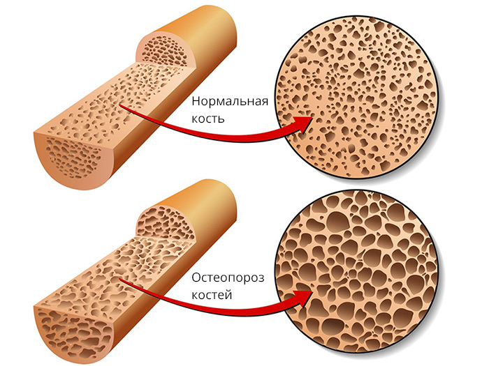 Минеральная плотность костной ткани - норма и остеопороз
