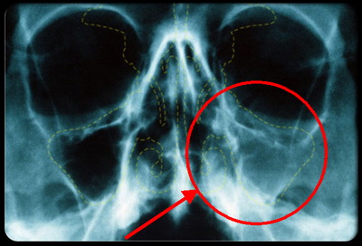 Рентген околоносовых пазух - как выглядит