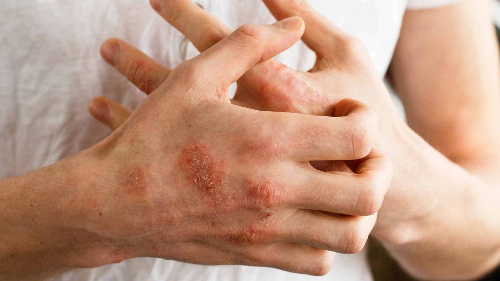 атопический дерматит на руках