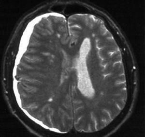 Гематома головного мозга - симптомы и лечение thumbnail