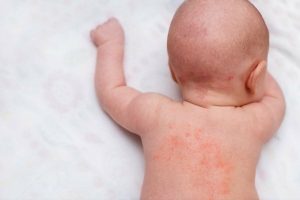 аллергия у малыша