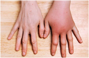 рука опухла от укуса - аллергическая реакция на коже