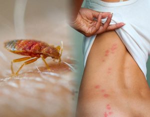 укус насекомых - аллергия на коже