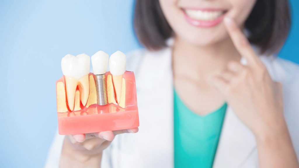 Имплантация зубов и протезирование