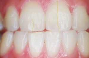 поврежденная эмаль зубов