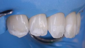 зубы с белыми пятнами
