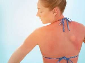 Аллергия, которой не было. Хроническая крапивница 5 аллергия на солнце