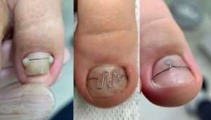 лечение вросшего ногтя