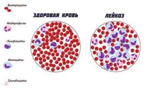 лейкоз кровь