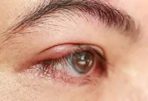 Ячмень и халязион. Как лечить ячмень?
