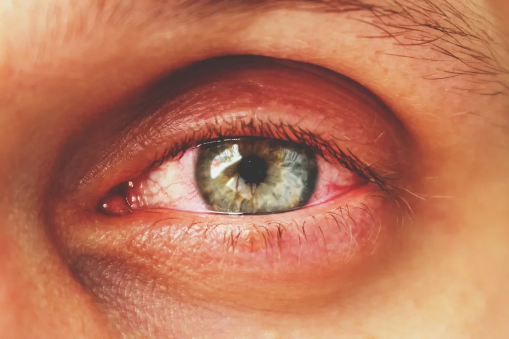 воспалительные заболевания глаз