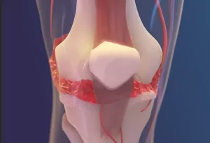 сустав опухает