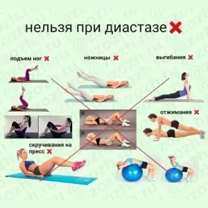 нельзя делать при диастазе