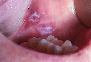 злокачественные заболевания полости рта