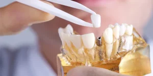 ограничения для имплантации зубов