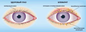 Сравнение здорового глаза и с блефаритом
