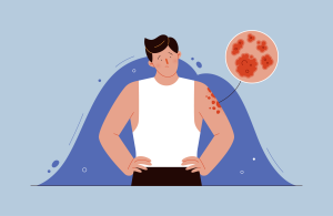 лечение псориаза