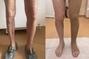 лимфедема 2 степени