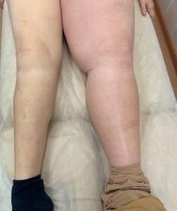 лимфедема на фоне онкологии