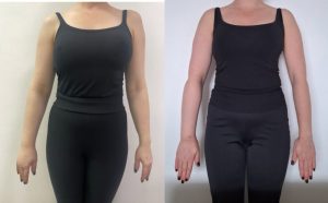 лимфедема правой руки