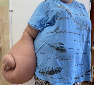 слоновость